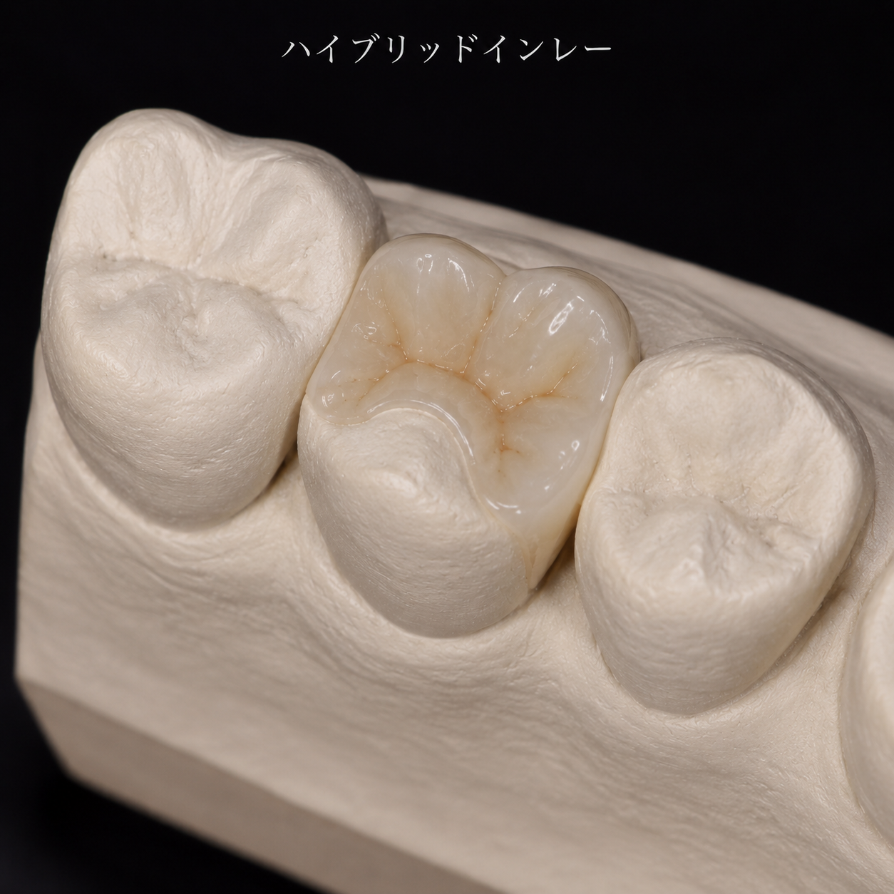 ハイブリッドインレー
