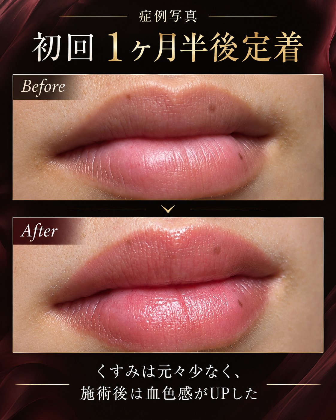 沖縄でリップアートメイクやるなら中城村のドリーム歯科。歯科麻酔と